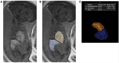 The interplay between prenatal liver growth and lung development in congenital diaphragmatic hernia